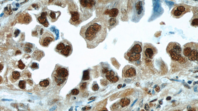 Immunohistochemical of paraffin-embedded human lung cancer using Catalog No:111386(HDGF antibody) at dilution of 1:100 (under 40x lens)