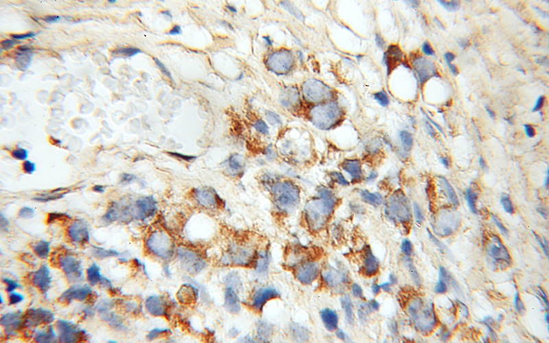 Immunohistochemical of paraffin-embedded human prostate cancer using Catalog No:114920(RRAS antibody) at dilution of 1:50 (under 10x lens)
