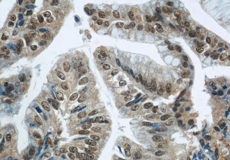 Immunohistochemical of paraffin-embedded human ovary tumor using Catalog No:116964(ZNF24 antibody) at dilution of 1:50 (under 40x lens)