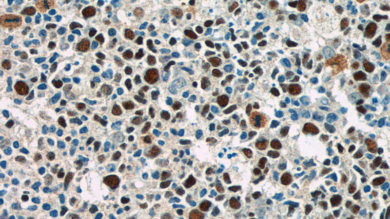 Immunohistochemistry of paraffin-embedded human tonsillitis tissue slide using Catalog No:112552(MCM2 Antibody) at dilution of 1:50 (under 40x lens)