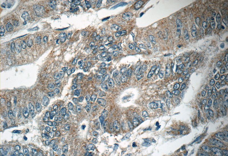 Immunohistochemistry of paraffin-embedded human colon cancer tissue slide using Catalog No:108194(NUAK1 Antibody) at dilution of 1:50 (under 40x lens)