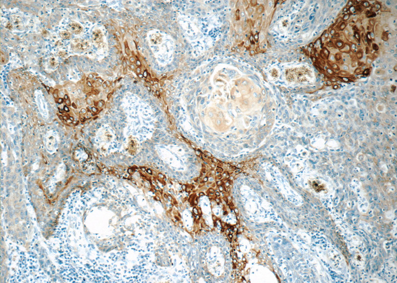 Immunohistochemistry of paraffin-embedded human oesophagus cancer tissue slide using Catalog No:109794(KRT15 Antibody) at dilution of 1:50 (under 10x lens)
