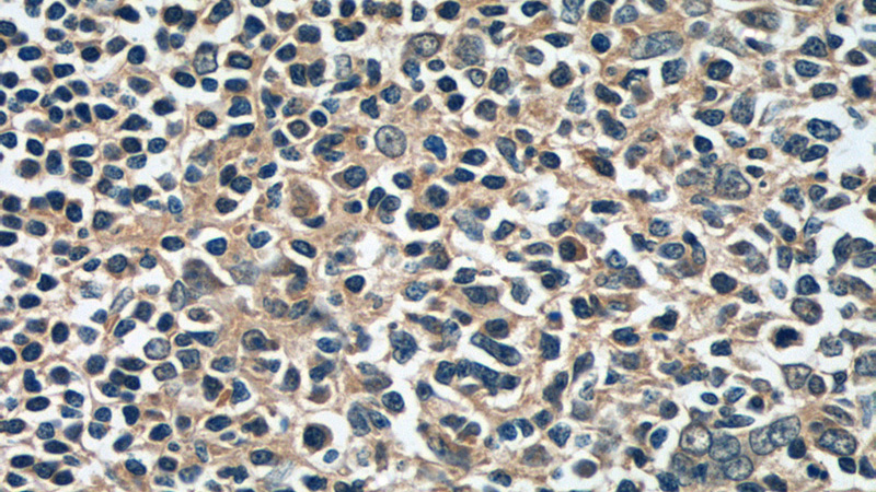 Immunohistochemistry of paraffin-embedded human tonsillitis tissue slide using Catalog No:109961(DNASE2B Antibody) at dilution of 1:50 (under 40x lens)