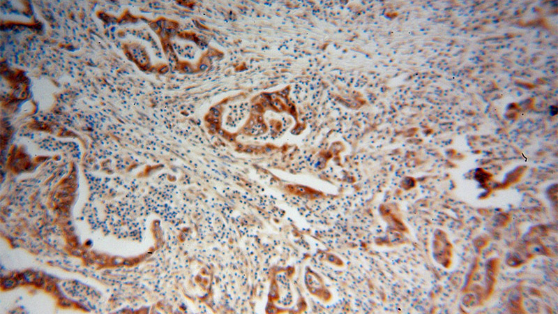 Immunohistochemical of paraffin-embedded human pancreas cancer using Catalog No:107249(EEF1D antibody) at dilution of 1:100 (under 10x lens)