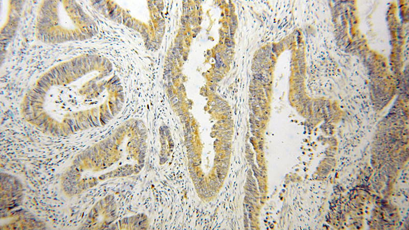 Immunohistochemical of paraffin-embedded human colon cancer using Catalog No:107717(ACAD9 antibody) at dilution of 1:50 (under 10x lens)