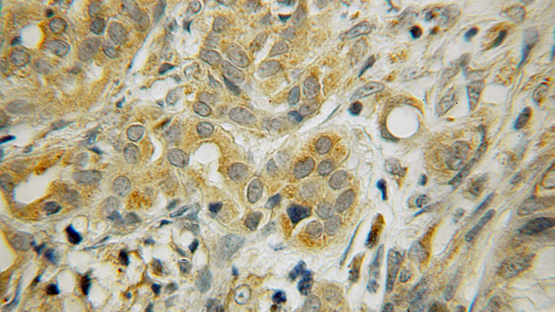 Immunohistochemical of paraffin-embedded human pancreas cancer using Catalog No:108149(ARMC3 antibody) at dilution of 1:100 (under 10x lens)