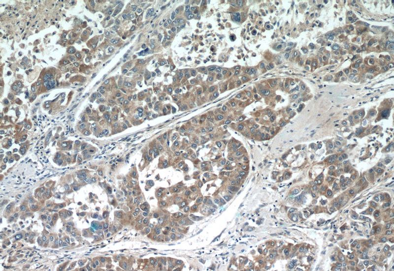 Immunohistochemistry of paraffin-embedded human liver cancer tissue slide using Catalog No:115207(SERPIND1 Antibody) at dilution of 1:50 (under 10x lens)