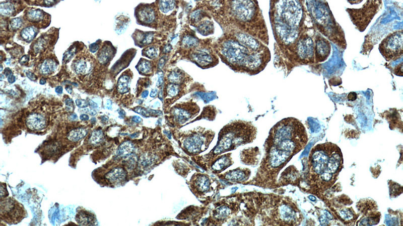 Immunohistochemical of paraffin-embedded human lung cancer using Catalog No:114156(PPPDE1 antibody) at dilution of 1:50 (under 40x lens)