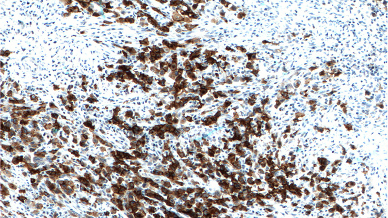 Immunohistochemistry of paraffin-embedded human T-cell anaplastic large cell lymphoma (ALCL) tissue slide using Catalog No:109022(TNFRSF8 Antibody) at dilution of 1:200 (under 10x lens). Heat mediated antigen retrieved with Tris-EDTA buffer(pH9).