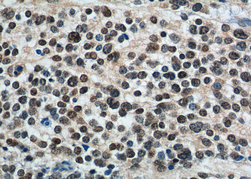 Immunohistochemistry of paraffin-embedded neuroblastoma tissue slide using (PHOX2B Antibody) at dilution of 1:500 (under 40x lens).