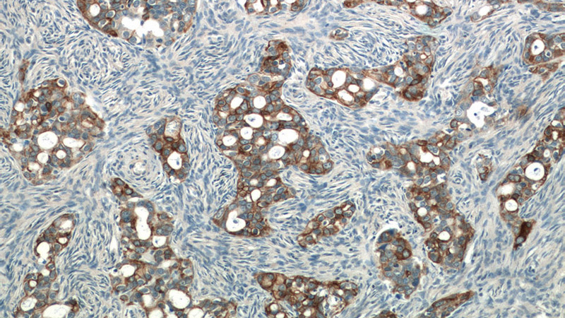 Immunohistochemistry of paraffin-embedded human ovary tumor tissue slide using Catalog No:109342(Claudin 4-specific Antibody) at dilution of 1:50 (under 10x lens)