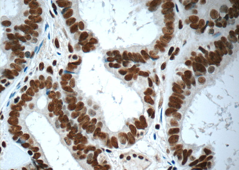 Immunohistochemistry of paraffin-embedded human ovary tumor tissue slide using Catalog No:110795(FUS/TLS Antibody) at dilution of 1:50 (under 40x lens)