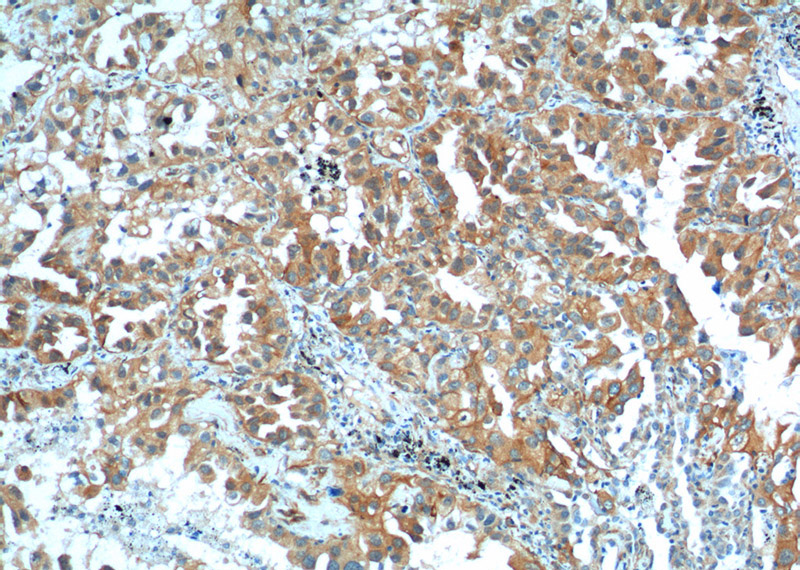 Immunohistochemistry of paraffin-embedded human lung cancer tissue slide using Catalog No:114959(S100A16 Antibody) at dilution of 1:200 (under 10x lens).