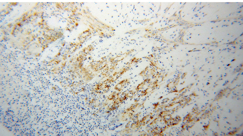 Immunohistochemical of paraffin-embedded human stomach cancer using Catalog No:115543(SPARC antibody) at dilution of 1:100 (under 10x lens)