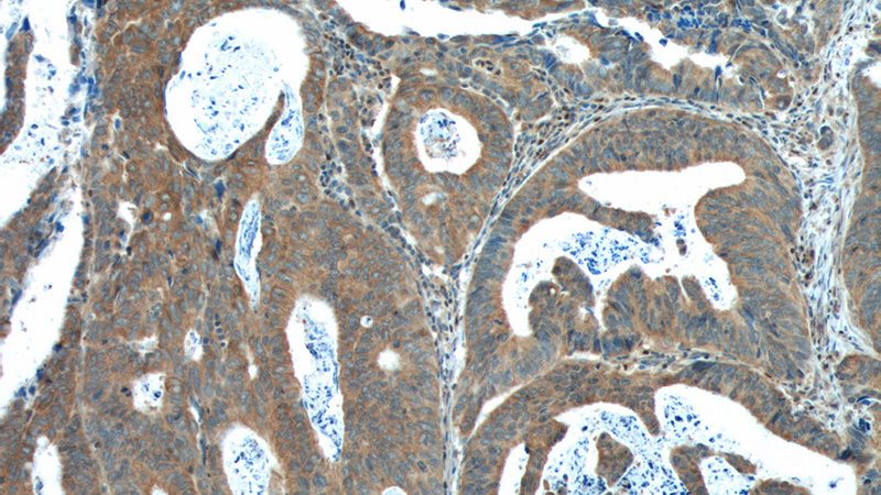 Immunohistochemistry of paraffin-embedded human colon cancer tissue slide using Catalog No:110514(FANCA Antibody) at dilution of 1:100 (under 10x lens).