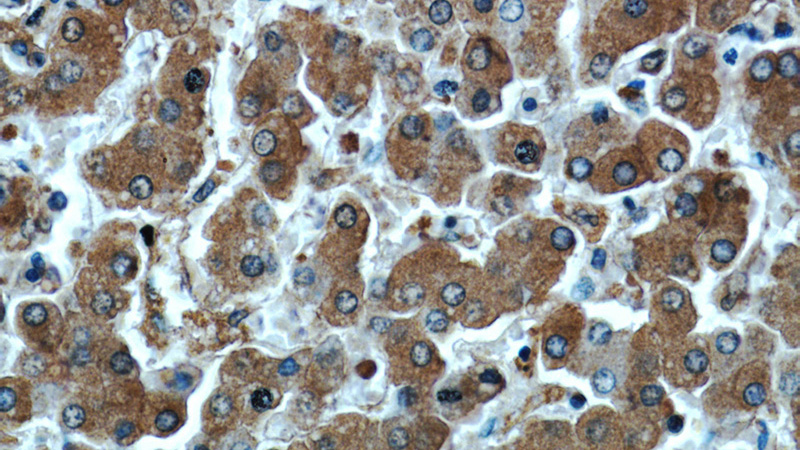 Immunohistochemical of paraffin-embedded human liver using Catalog No:107580(Alpha-1-Antitrypsin antibody) at dilution of 1:50 (under 40x lens)