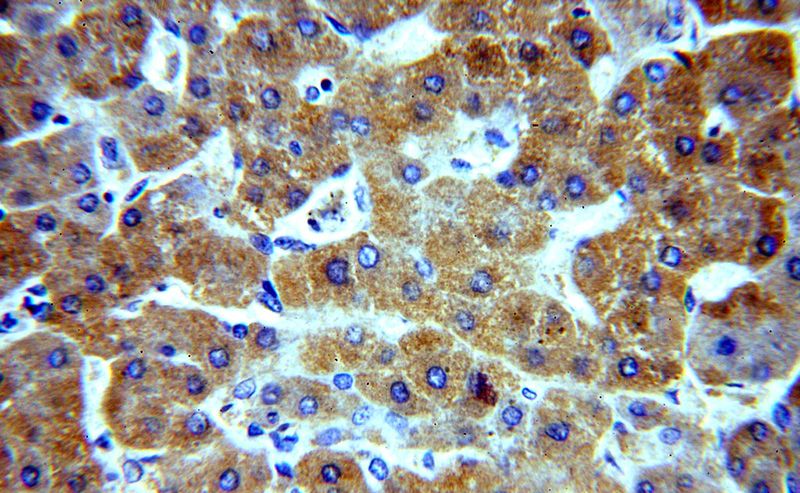 Immunohistochemical of paraffin-embedded human hepatocirrhosis using Catalog No:115064(SAR1A antibody) at dilution of 1:100 (under 40x lens)