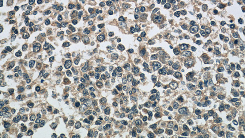 Immunohistochemistry of paraffin-embedded human tonsillitis tissue slide using Catalog No:108293(ATG2A Antibody) at dilution of 1:50 (under 40x lens)