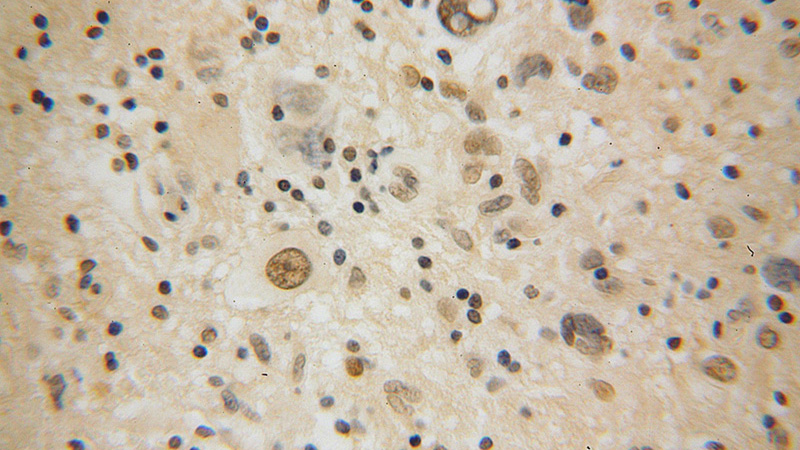 Immunohistochemical of paraffin-embedded human gliomas using Catalog No:114722(RMI1 antibody) at dilution of 1:100 (under 40x lens)