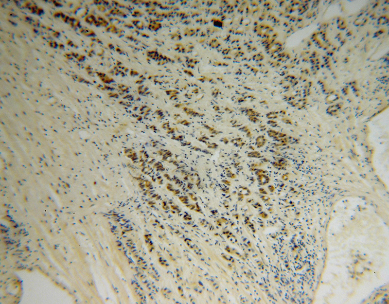Immunohistochemical of paraffin-embedded human gliomas using Catalog No:107847(AHSA1 antibody) at dilution of 1:50 (under 10x lens)