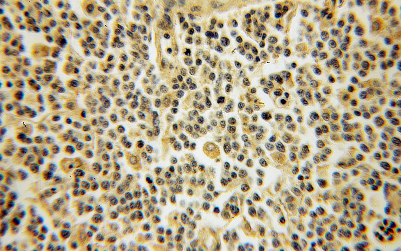 Immunohistochemical of paraffin-embedded human lymphoma using Catalog No:110145(DYRK4 antibody) at dilution of 1:100 (under 10x lens)