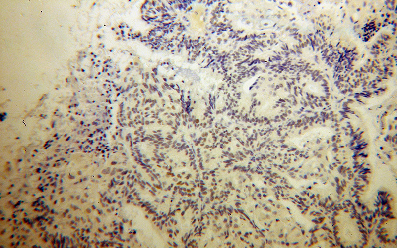 Immunohistochemical of paraffin-embedded human ovary tumor using Catalog No:113815(PHF6 antibody) at dilution of 1:50 (under 10x lens)