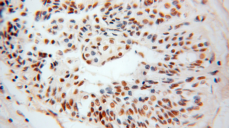 Immunohistochemical of paraffin-embedded human breast cancer using Catalog No:114800(POLR2E antibody) at dilution of 1:100 (under 40x lens)