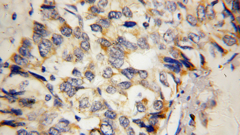 Immunohistochemical of paraffin-embedded human liver cancer using Catalog No:112779(MTHFS antibody) at dilution of 1:100 (under 40x lens)