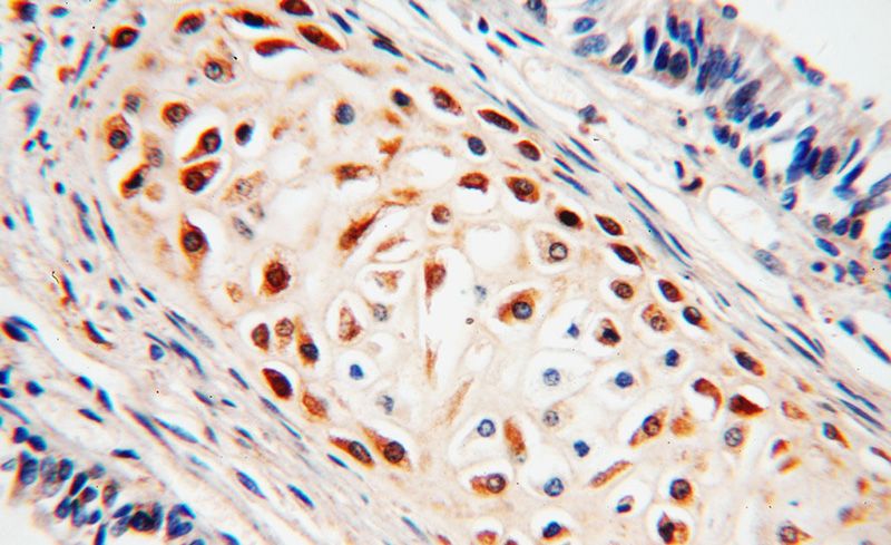 Immunohistochemical of paraffin-embedded human lung using Catalog No:117096(BCL2L10 antibody) at dilution of 1:50 (under 40x lens)