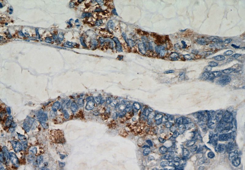 Immunohistochemical of paraffin-embedded human colon cancer using Catalog No:114661(RHOF antibody) at dilution of 1:50 (under 40x lens)