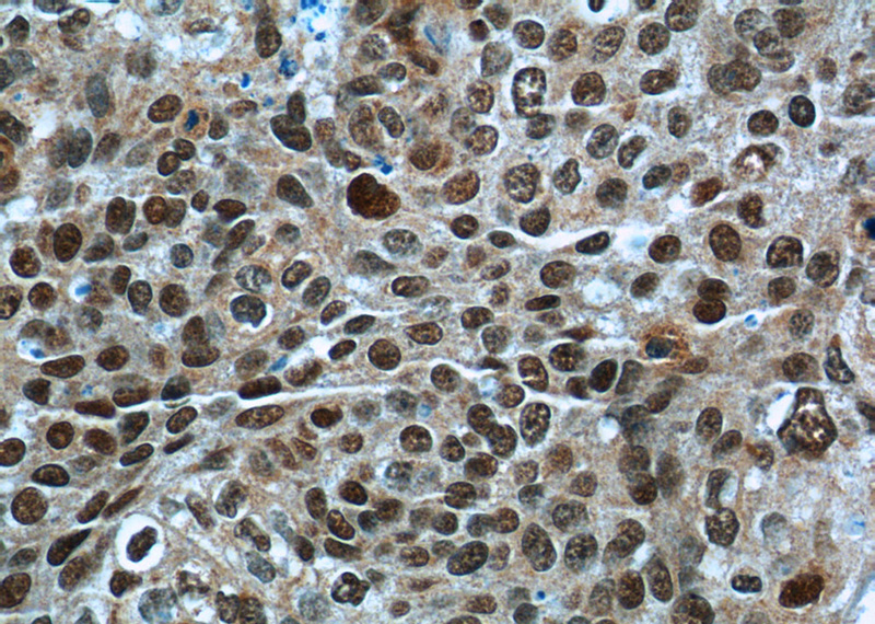 Immunohistochemistry of paraffin-embedded human cervical cancer tissue slide using Catalog No:111501(HNRNPA2B1 Antibody) at dilution of 1:50 (under 40x lens)