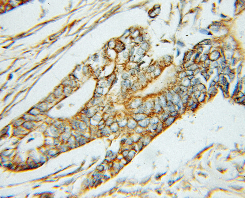 Immunohistochemical of paraffin-embedded human pancreas cancer using Catalog No:107679(ABAT antibody) at dilution of 1:50 (under 10x lens)