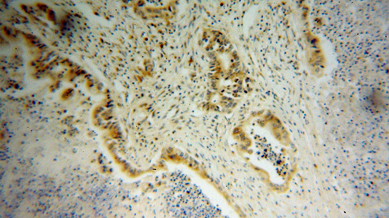 Immunohistochemical of paraffin-embedded human pancreas cancer using Catalog No:113170(NGB antibody) at dilution of 1:100 (under 10x lens)