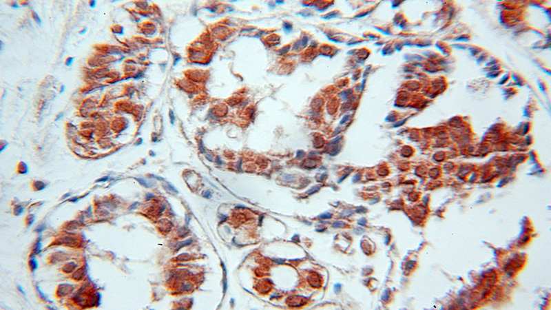 Immunohistochemical of paraffin-embedded human breast cancer using Catalog No:115572(SPIN2B antibody) at dilution of 1:50 (under 25x lens)