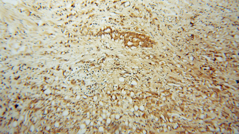 Immunohistochemical of paraffin-embedded human prostate cancer using Catalog No:108232(ASMTL antibody) at dilution of 1:100 (under 10x lens)
