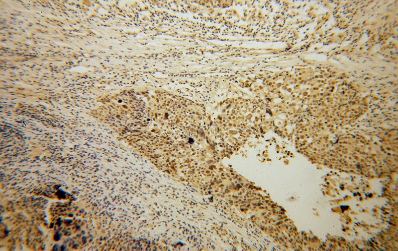 Immunohistochemical of paraffin-embedded human ovary tumor using Catalog No:108857(CARD8 antibody) at dilution of 1:50 (under 10x lens)