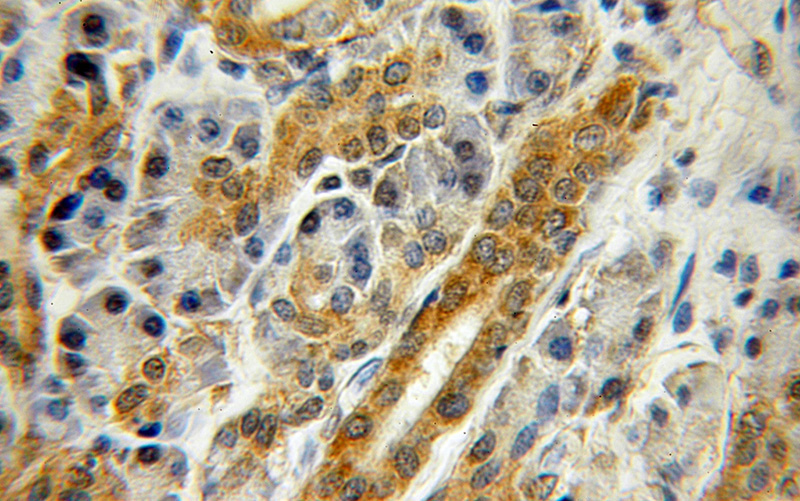 Immunohistochemical of paraffin-embedded human pancreas cancer using Catalog No:116958(ZNF2 antibody) at dilution of 1:50 (under 10x lens)