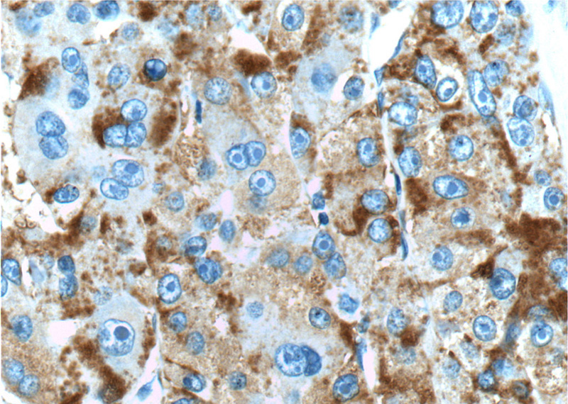 Immunohistochemistry of paraffin-embedded human liver cancer tissue slide using Catalog No:107701(ACSM5 Antibody) at dilution of 1:50 (under 40x lens)