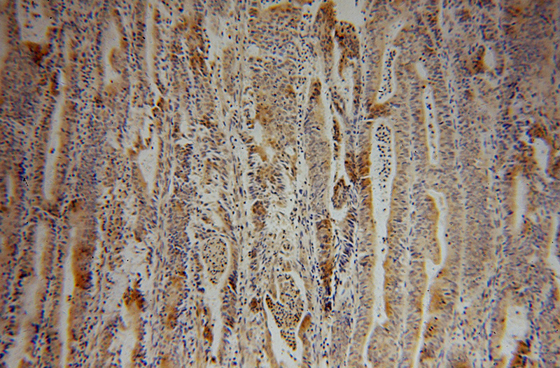 Immunohistochemical of paraffin-embedded human endometrial cancer using Catalog No:116514(UBA7 antibody) at dilution of 1:50 (under 10x lens)