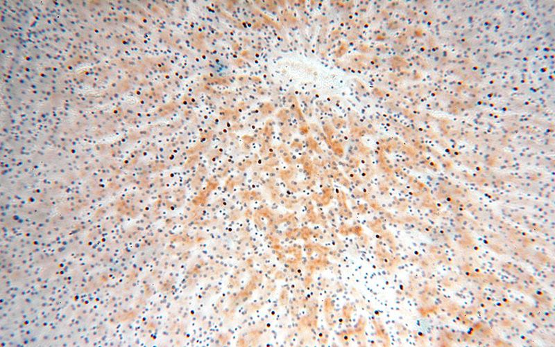 Immunohistochemical of paraffin-embedded human liver cancer using Catalog No:114901(RPL7L1 antibody) at dilution of 1:200 (under 10x lens)