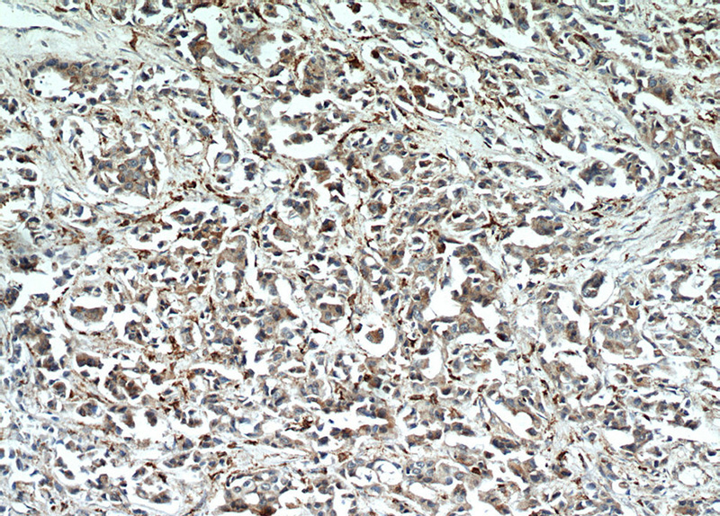 Immunohistochemical of paraffin-embedded human breast cancer using Catalog No:116852(WDFY3 antibody) at dilution of 1:50 (under 10x lens)