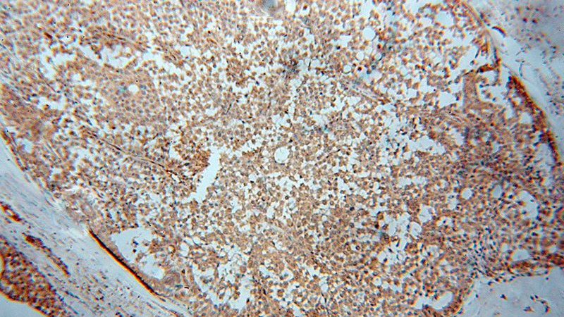 Immunohistochemical of paraffin-embedded human breast cancer using Catalog No:116520(UBE2D4 antibody) at dilution of 1:50 (under 10x lens)