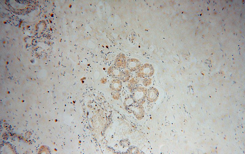 Immunohistochemical of paraffin-embedded human breast cancer using Catalog No:116776(VPS25 antibody) at dilution of 1:50 (under 10x lens)