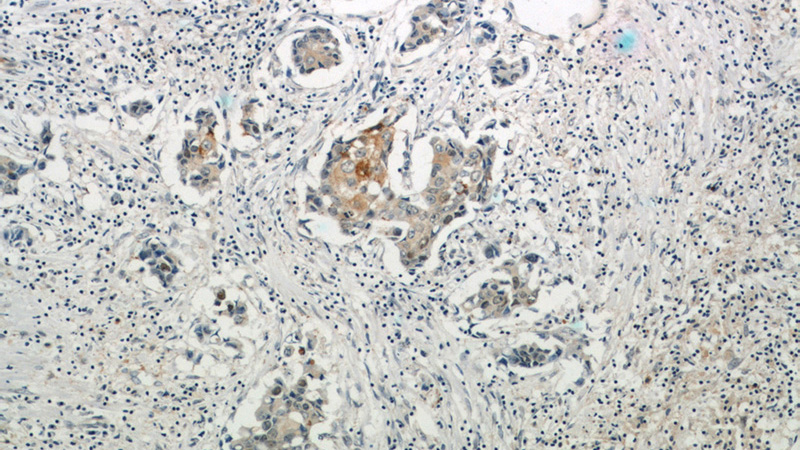 Immunohistochemical of paraffin-embedded human breast cancer using Catalog No:112380(MAGEA4 antibody) at dilution of 1:50 (under 10x lens)