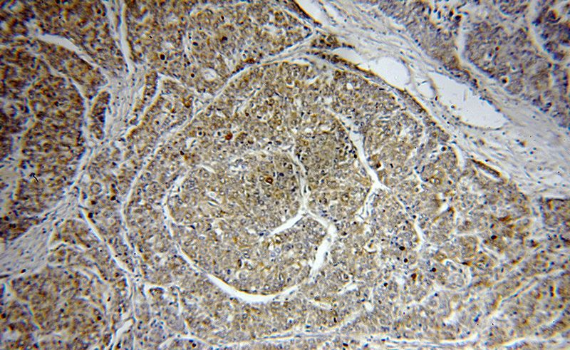 Immunohistochemical of paraffin-embedded human liver cancer using Catalog No:111261(C4orf15 antibody) at dilution of 1:100 (under 10x lens)