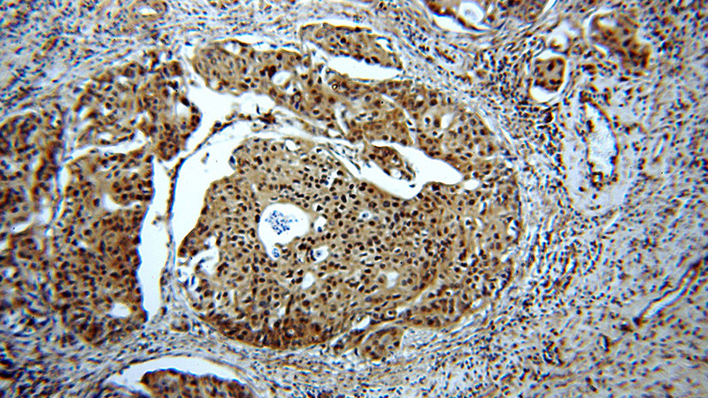 Immunohistochemical of paraffin-embedded human cervical cancer using Catalog No:109157(CDC2-Specific antibody) at dilution of 1:50 (under 10x lens)