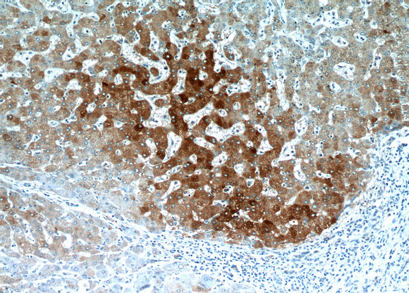 Immunohistochemical of paraffin-embedded human hepatocirrhosis using Catalog No:110580(FAM185A antibody) at dilution of 1:50 (under 10x lens)