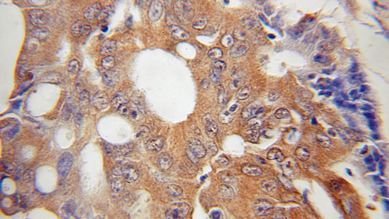 Immunohistochemical of paraffin-embedded human colon cancer using Catalog No:111727(HUS1 antibody) at dilution of 1:50 (under 10x lens)