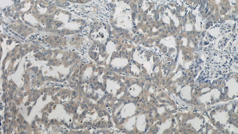 Immunohistochemistry of paraffin-embedded human lung cancer slide using Catalog No:107371(LAMR1,RPSA Antibody) at dilution of 1:50