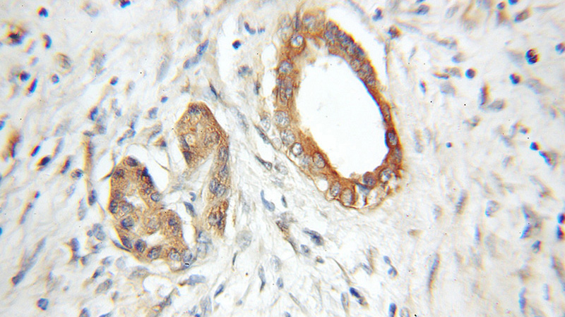Immunohistochemical of paraffin-embedded human pancreas cancer using Catalog No:114491(RABAC1 antibody) at dilution of 1:50 (under 10x lens)